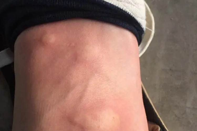 浅表性皮肤脂肪瘤痣胳膊疙瘩图 浅表性皮肤脂肪瘤痣胳膊疙瘩图