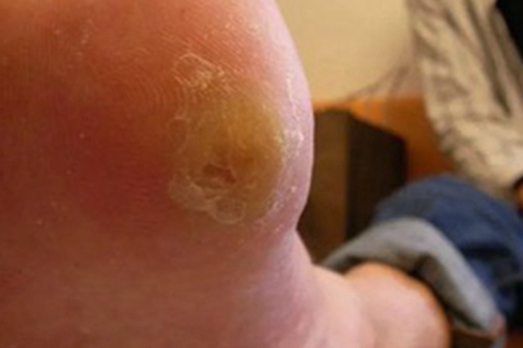 胼胝脚底下皮肤发黄变硬图
