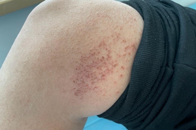 干性湿疹大腿红点图