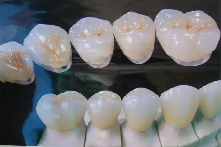 钛合金烤瓷牙图