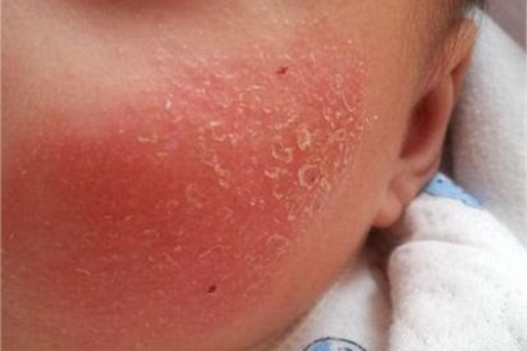 婴儿期特应性皮炎症状图