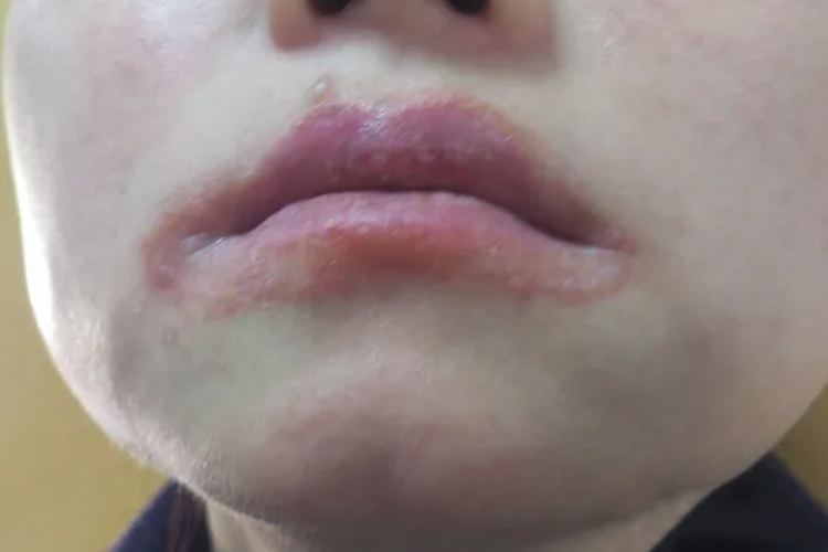 接触性皮炎嘴巴周围有红疹图