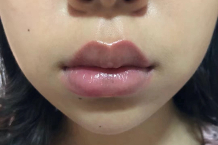 慢性唇炎嘴唇肿胀图