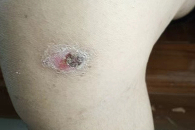 深脓疱疮膝盖结痂溃疡图