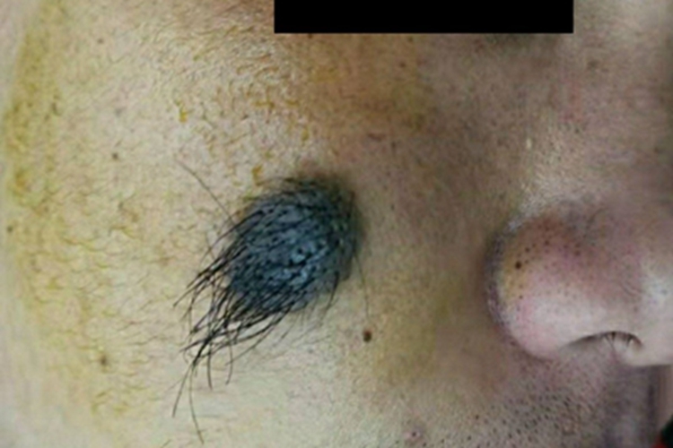 复合痣面部症状图