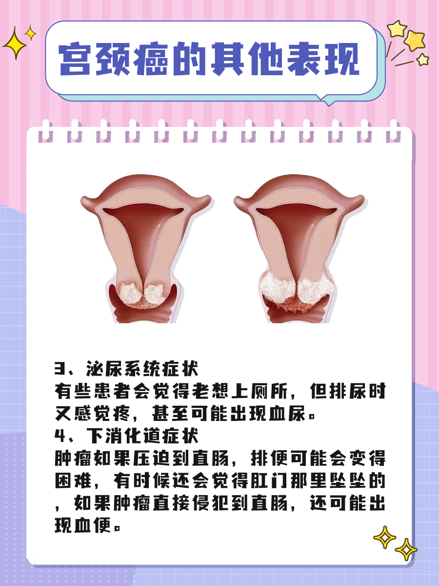 水样白带，漏尿一样多，是啥情况？