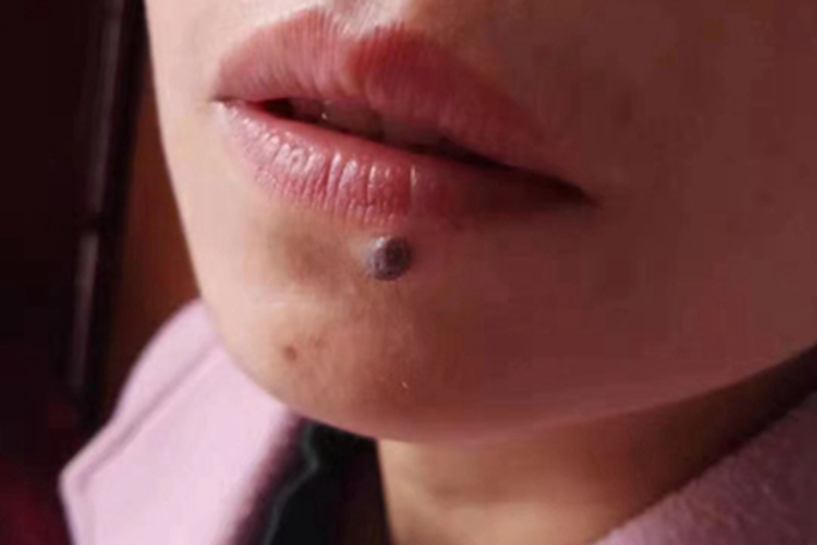 复合痣口周症状图