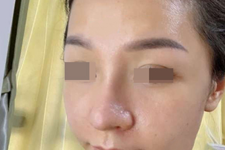 假体隆鼻7天拆线图