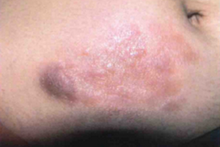 隆突性皮肤纤维肉瘤结节图