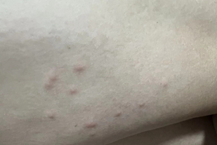 丘疹性荨麻疹大腿小疙瘩图