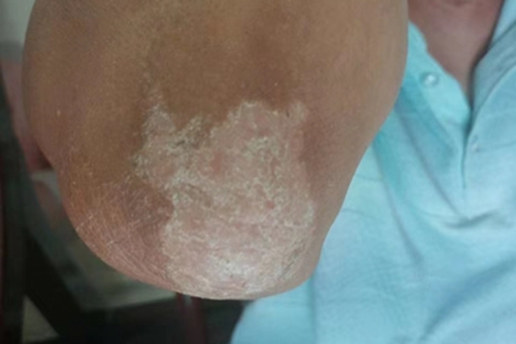 局限性神经性皮炎肘部脱皮图