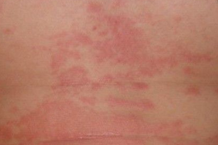 麻疹斑丘疹图