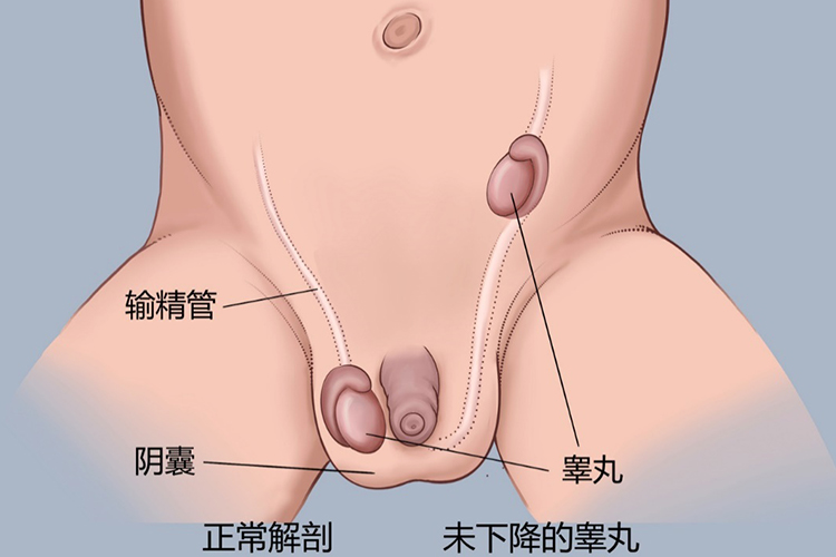儿童睾丸一上一下隐睾图 儿童睾丸一上一下隐睾图