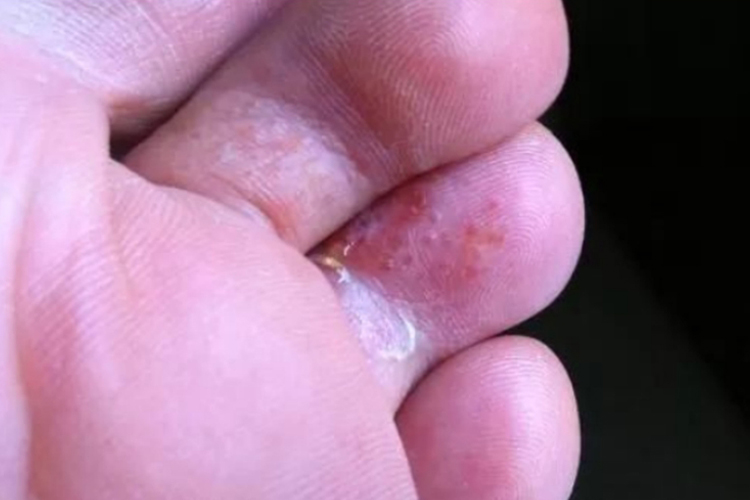 小孩手足癣图 小孩手足癣图