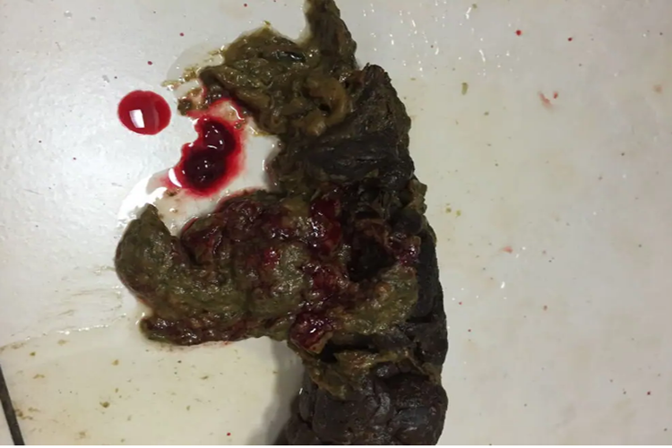 痔疮大便出血图