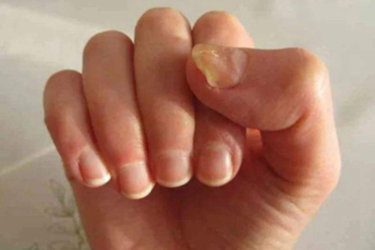 反甲手指甲粗糙图