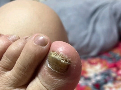 全甲损毁型甲真菌病脚趾甲增厚发黄图