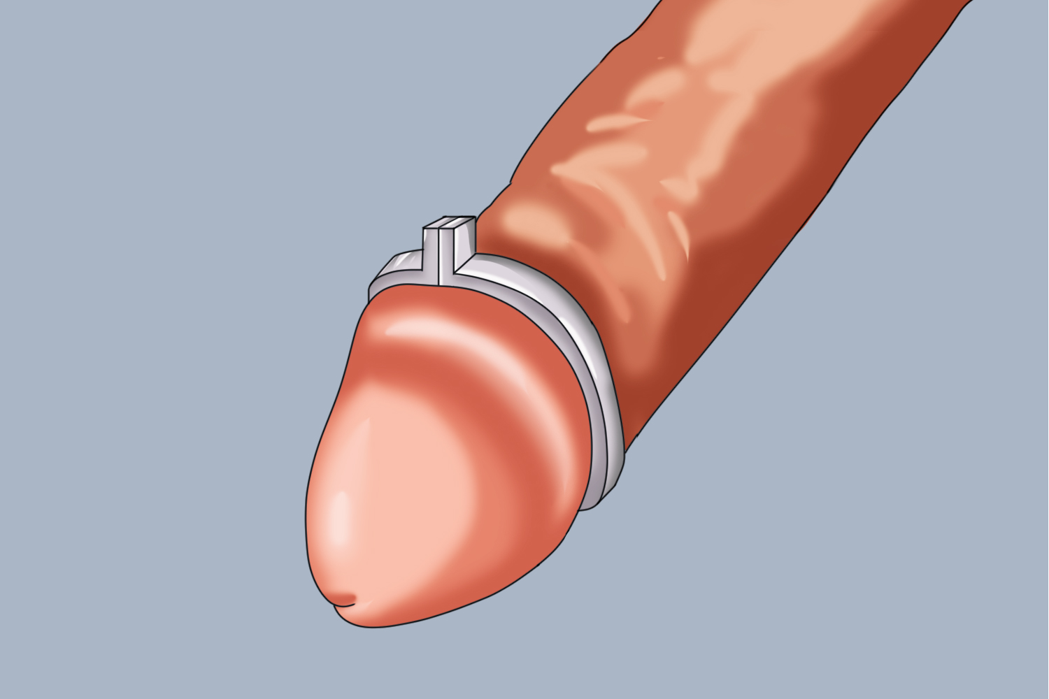包茎环扎术后留置内环图
