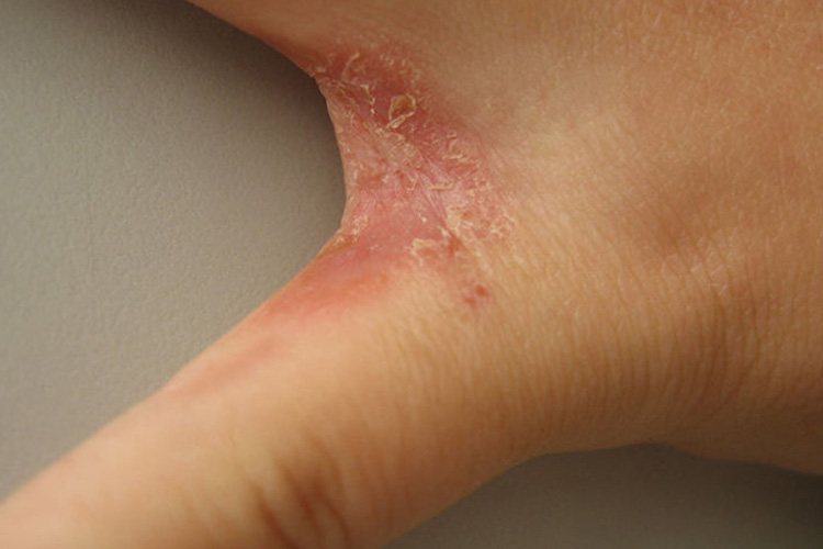 手癣常见于单侧,根据临床特点不同,可分为3种类型,即水疱型,鳞屑角化