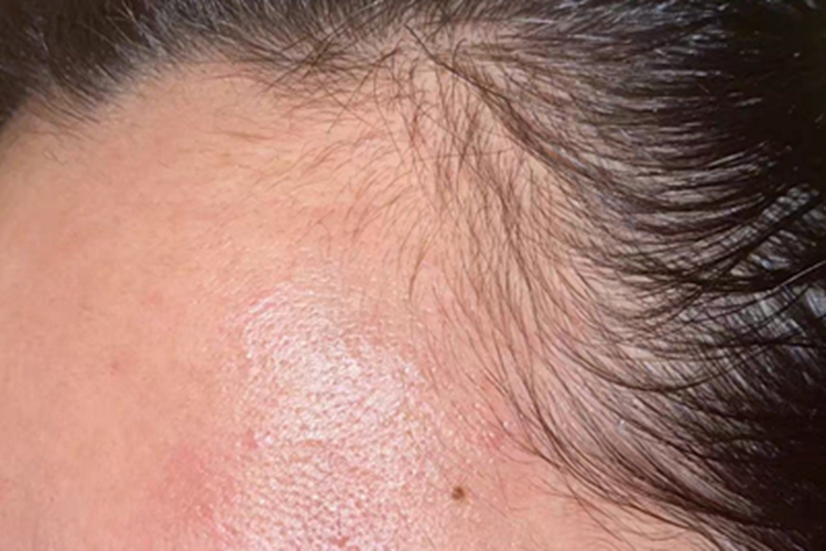 女性型脱发发际线后移图