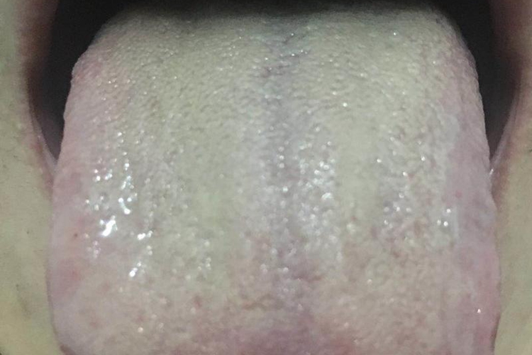 肝胆湿热证舌苔症状图