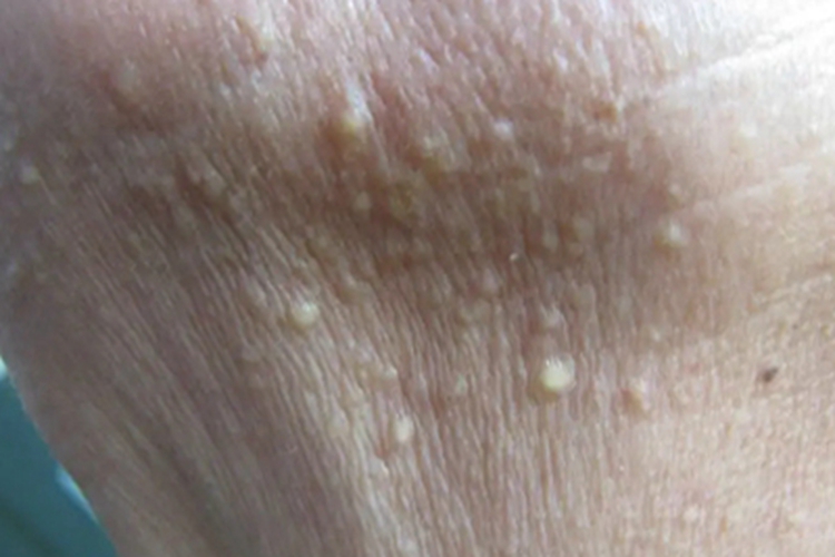 浅表性皮肤脂肪瘤痣颈部症状图