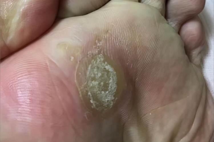 胼胝脚底脱皮有硬结图