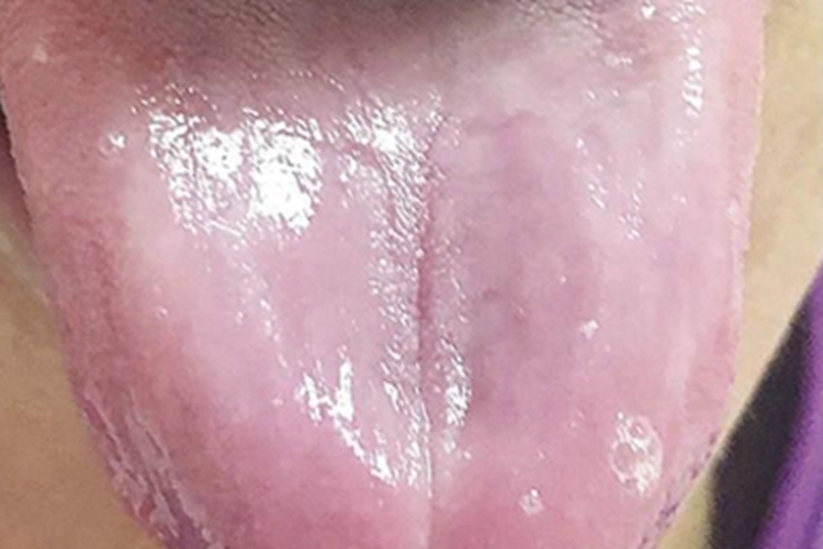 萎缩性舌炎发白图 萎缩性舌炎发白图