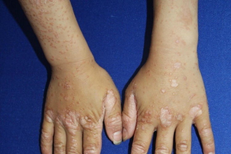 毛发红糠疹手背症状图 毛发红糠疹手背症状图