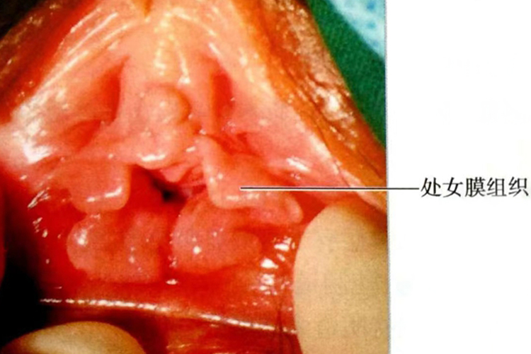 已经破裂的处女膜图