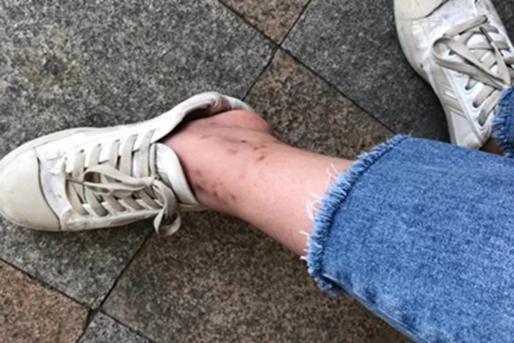 虫咬皮炎脚踝斑图 虫咬皮炎脚踝斑图