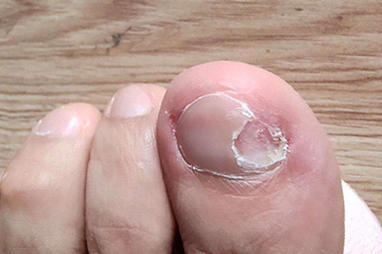 脱甲病脚趾甲症状图