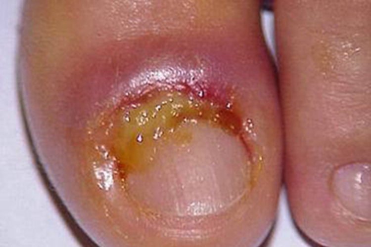 甲床炎发黄图 甲床炎发黄图