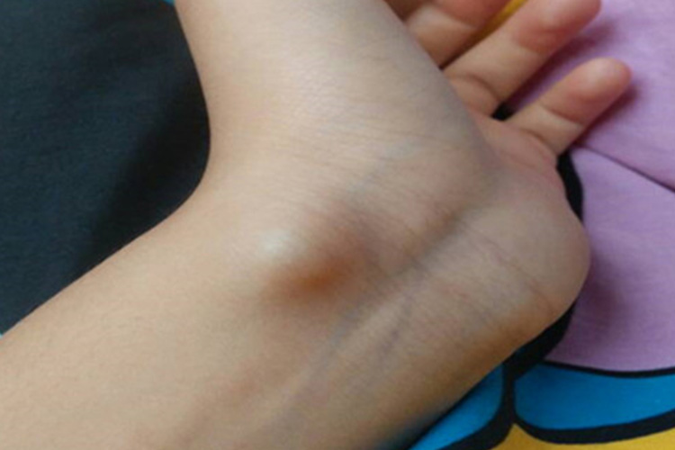 手腕内侧腱鞘囊肿图