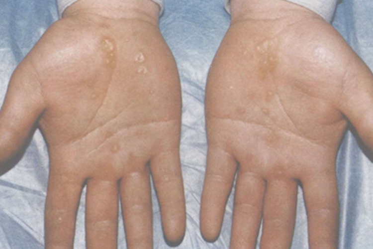 更年期角皮症手掌丘疹图