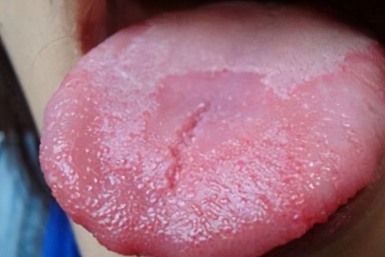 沟纹舌伴地图舌图