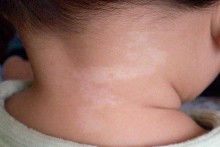 幼儿无色素性痣早期图