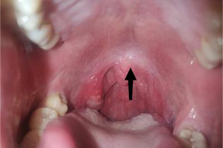 慢性扁桃体炎咽喉症状图