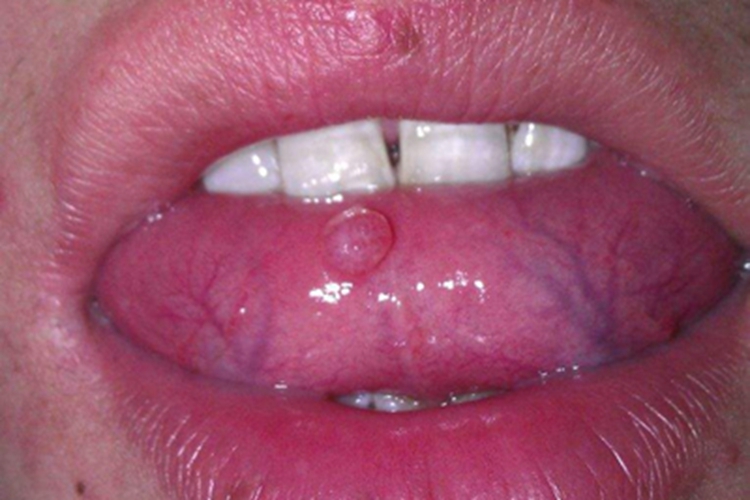 舌癌舌下有一个红色结节图