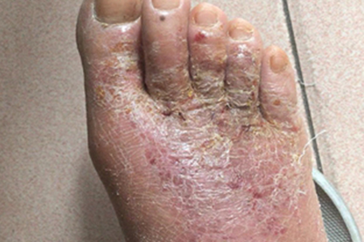 亚急性湿疹脚背结痂图