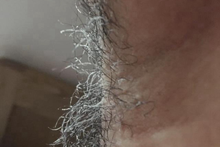 白色毛结节菌病腋窝症状图