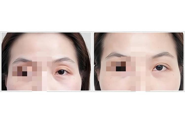 眼窝凹陷脂肪填充图 眼窝凹陷脂肪填充图