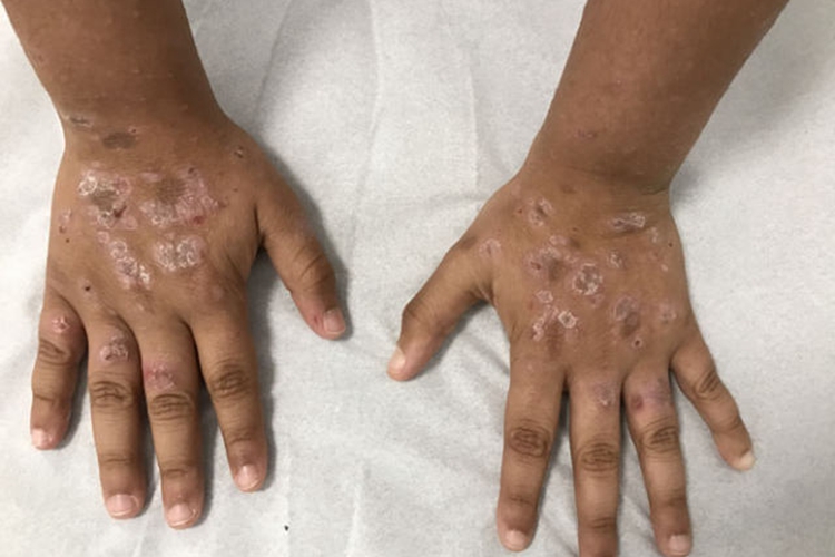 青年成人期特应性皮炎手背白斑图