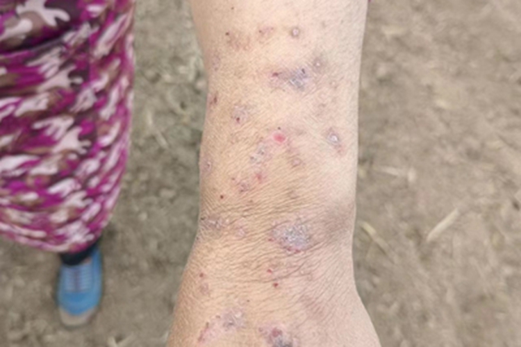 慢性湿疹胳膊图