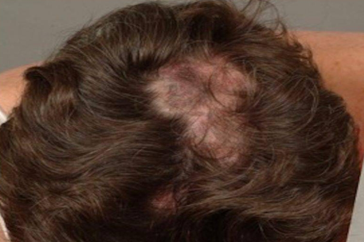 红斑狼疮头发稀少图