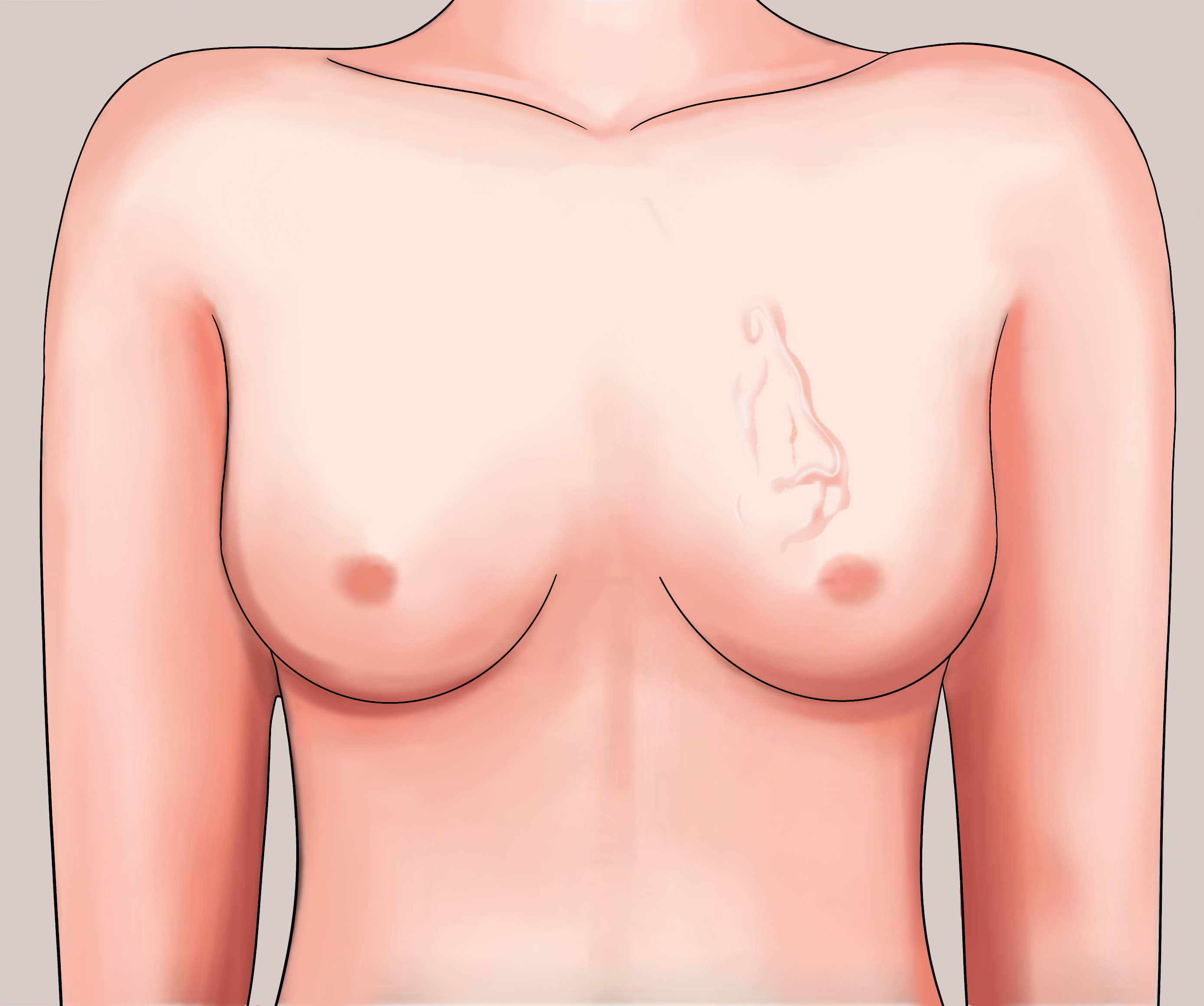 乳腺叶状肿瘤表面浅静脉怒张图