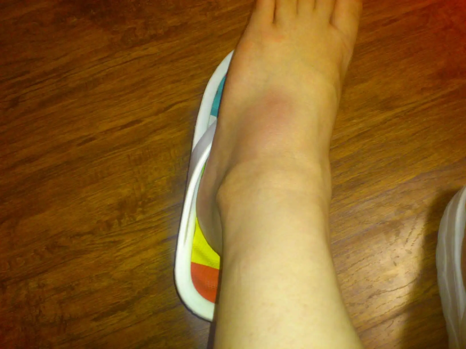 崴脚脚踝红肿图