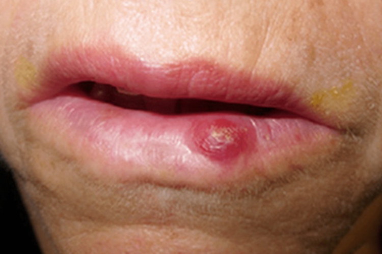 Merkel细胞癌大红疙瘩图 Merkel细胞癌大红疙瘩图