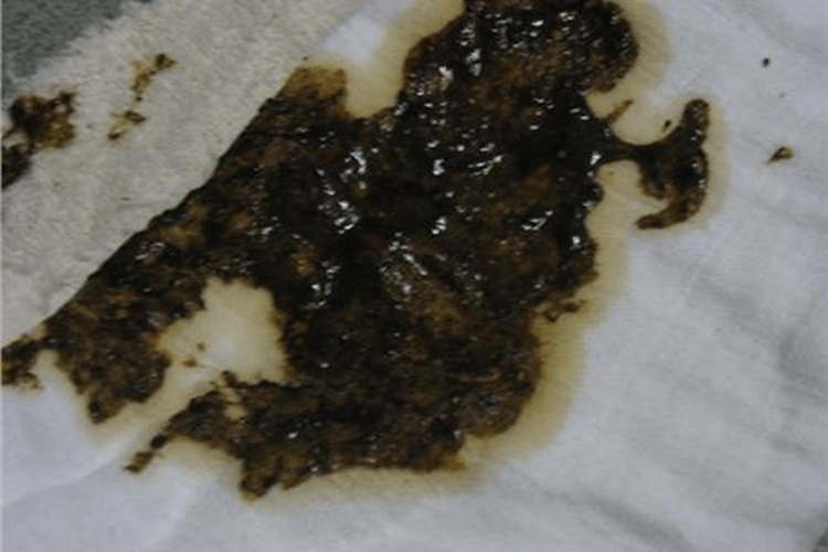 阿米巴痢疾图 阿米巴痢疾图