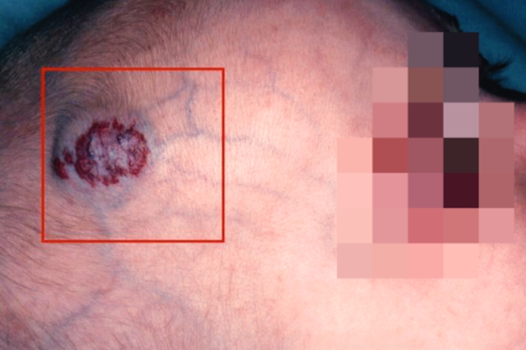 新生儿头部蔓状血管瘤图